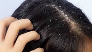 Anti-Dandruff Treatment
