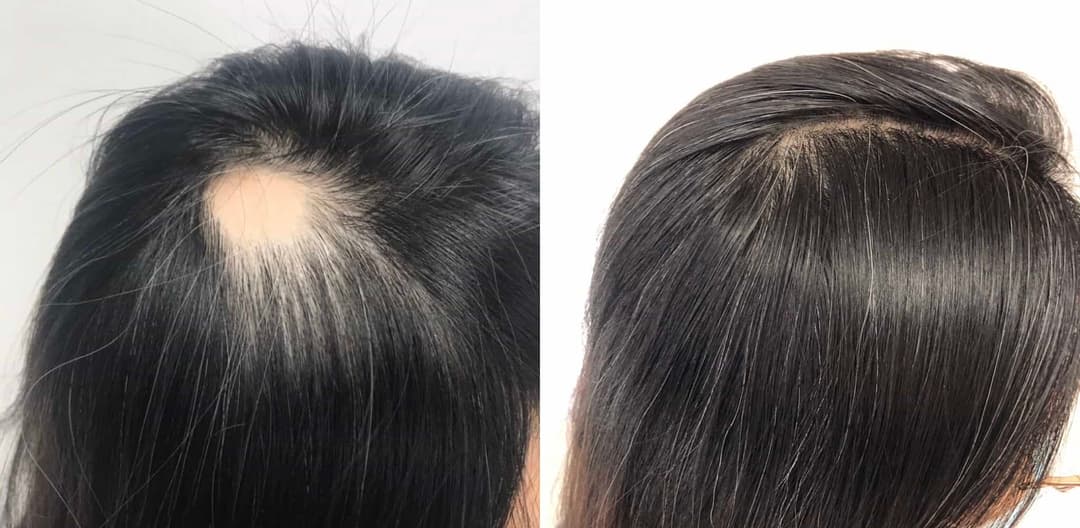 PRP Treatment