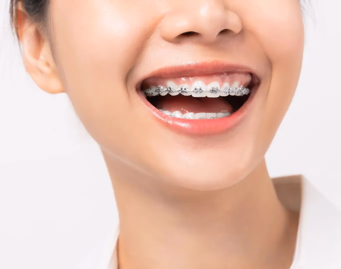 Braces