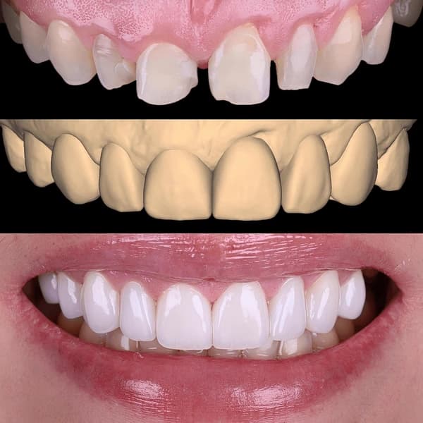 Crowns, Bridges & Veneers