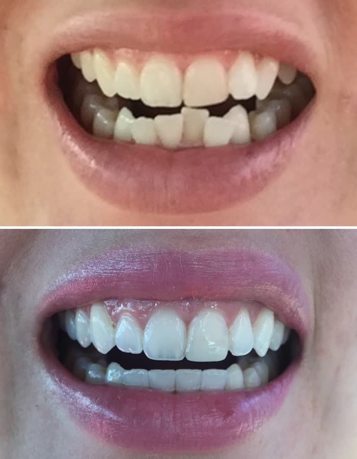 Invisalign