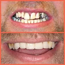 Root Canal Treatment