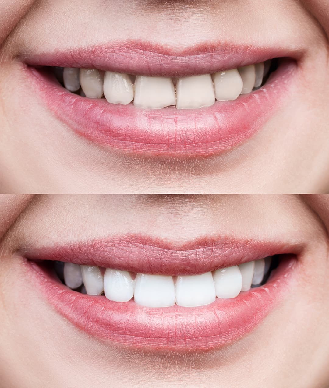 Smile Designing