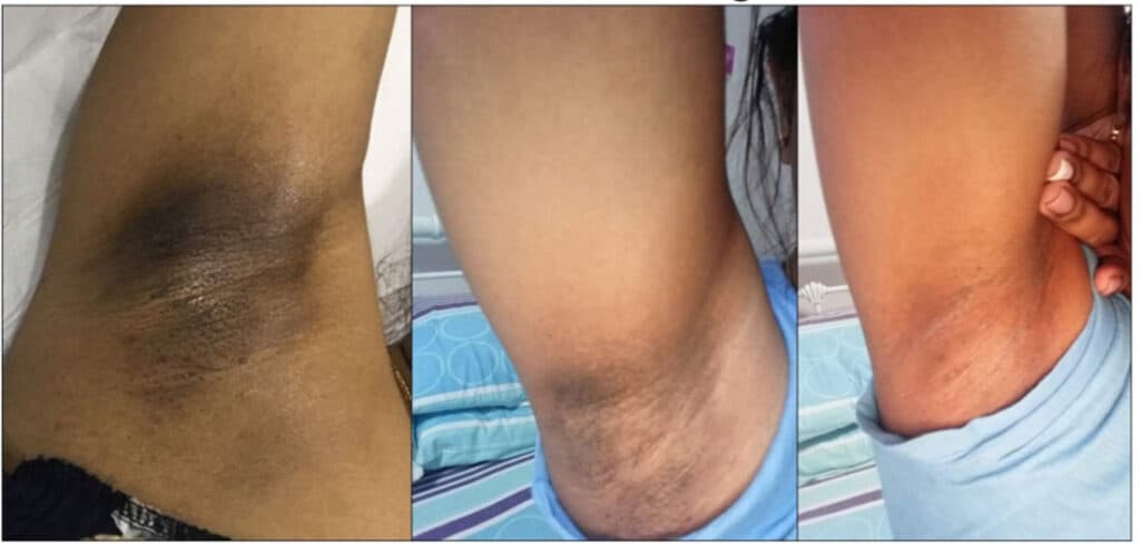 Body Peels