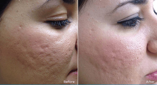 Collagen Treatment