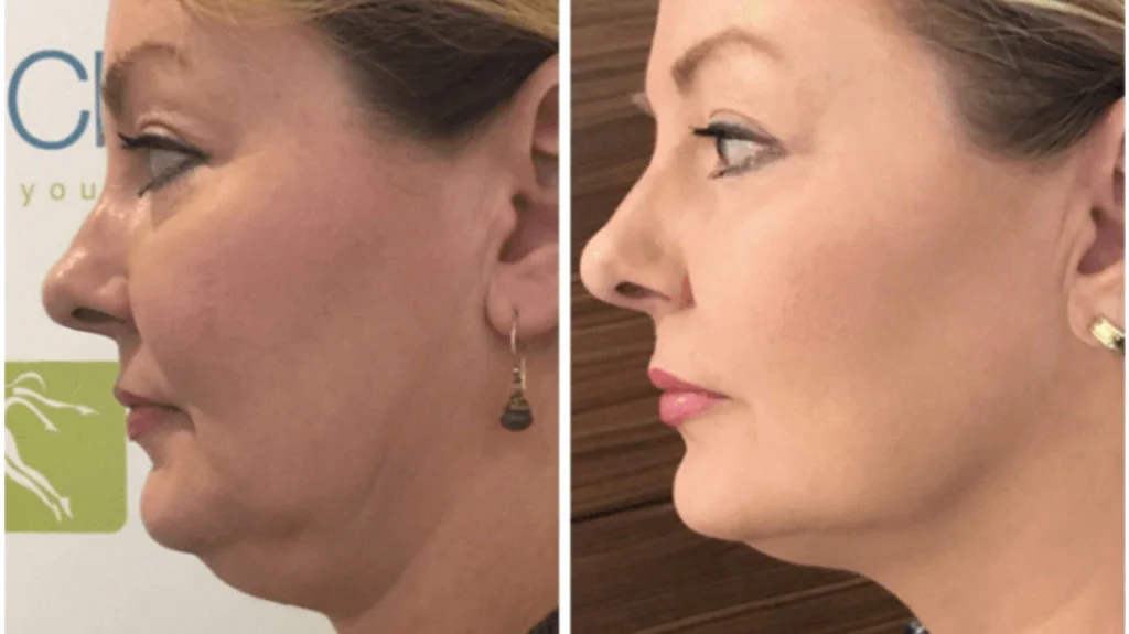 HIFU Fat Reduction