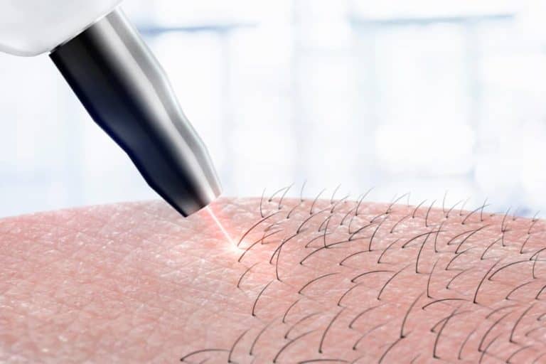 Laser Hair Reduction