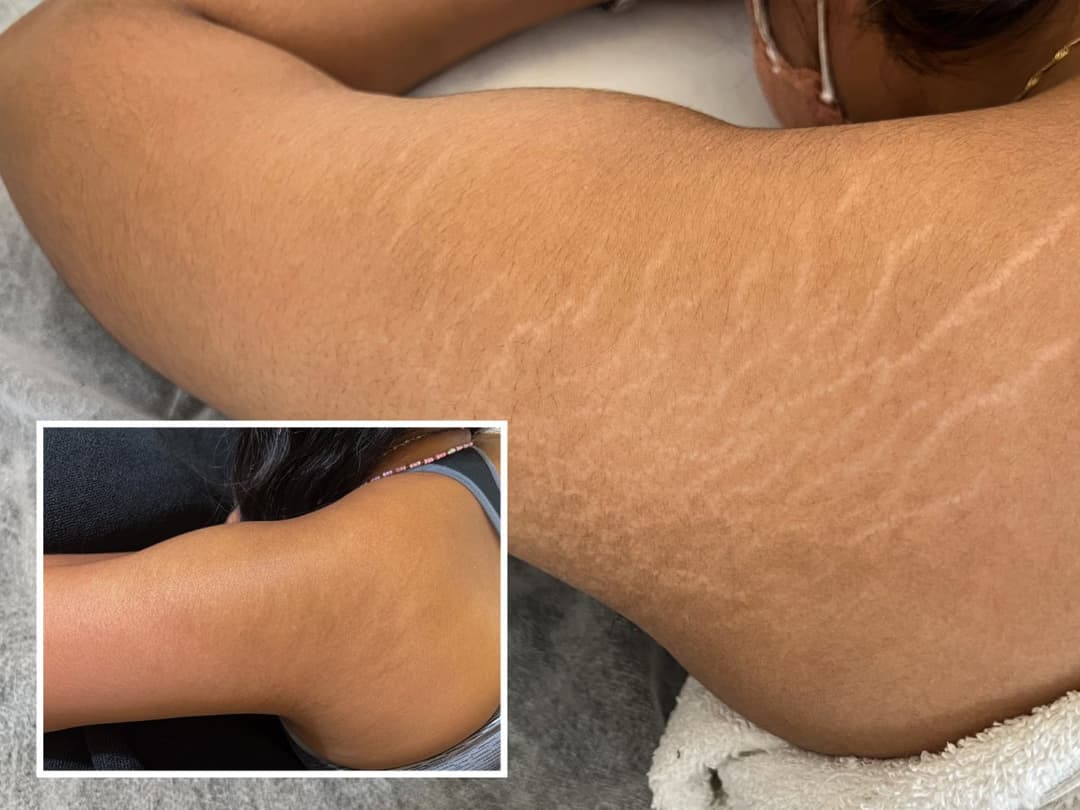 Stretch Marks