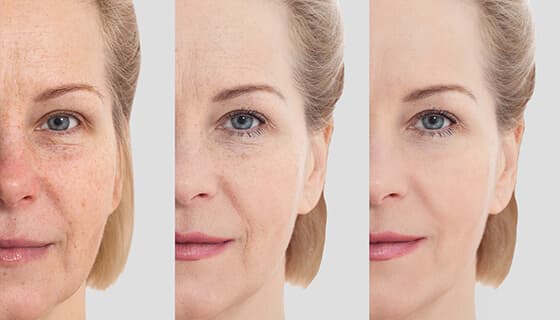 Skin Rejuvenation